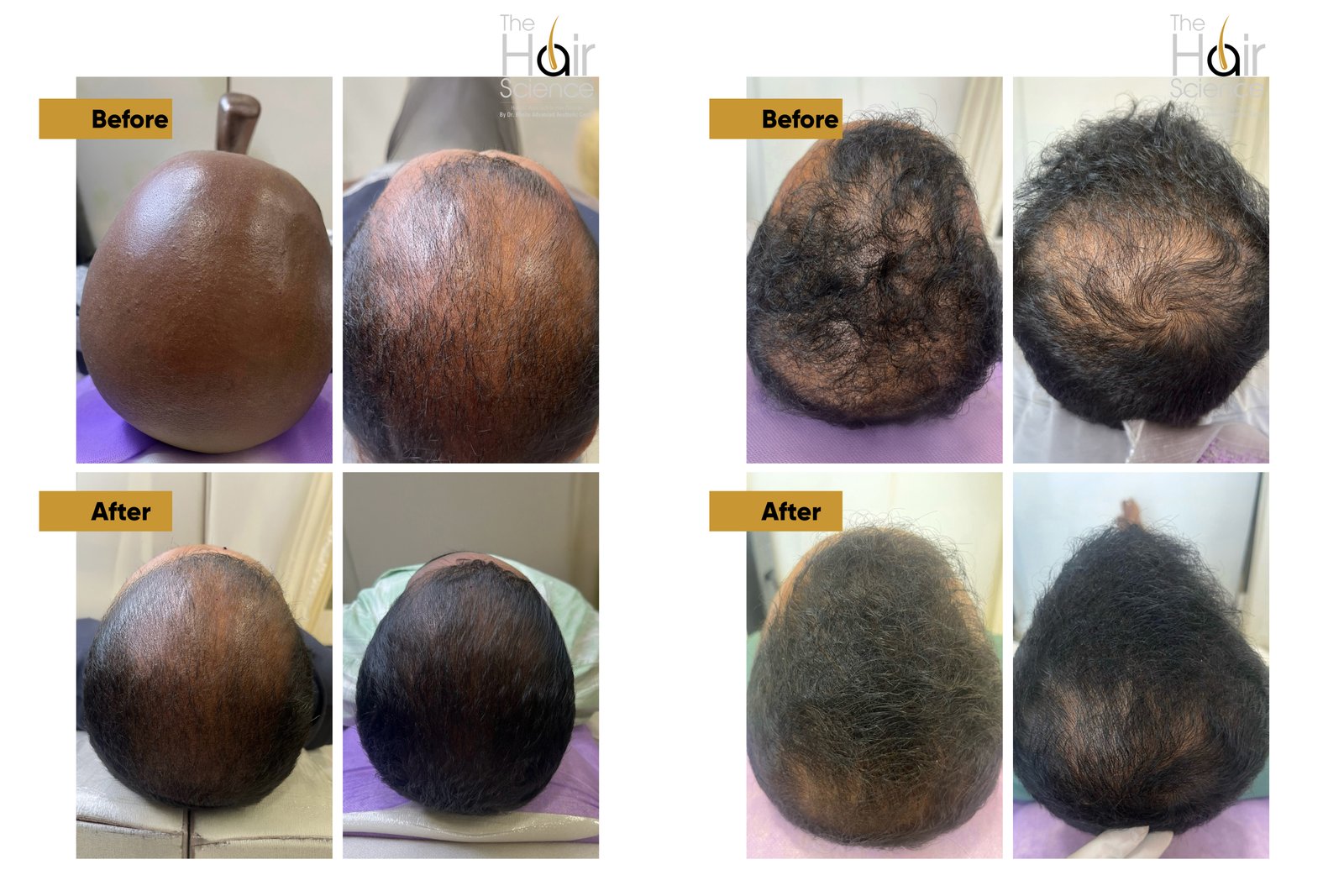 Hair restoration before and after