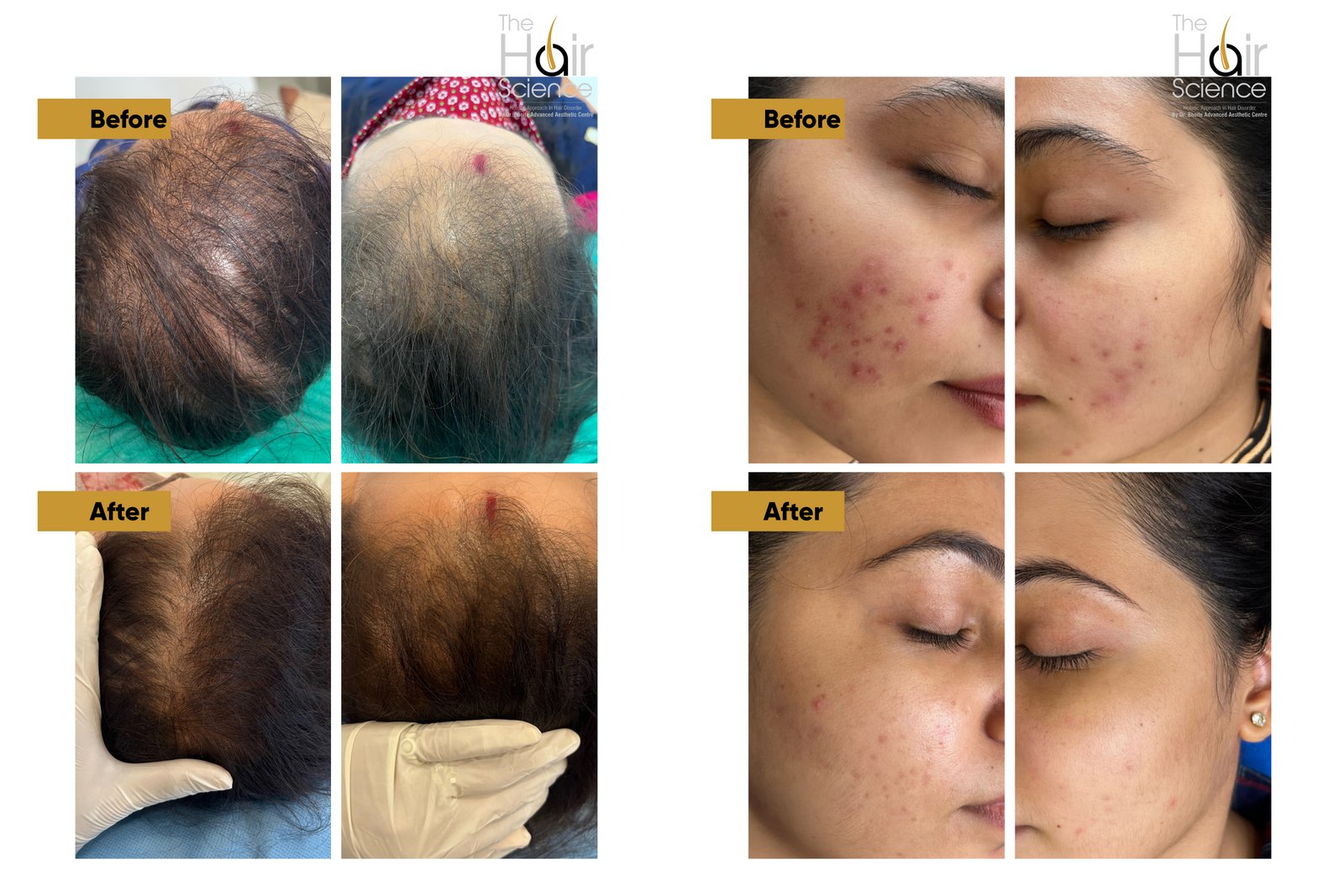 Eyebrow restoration results