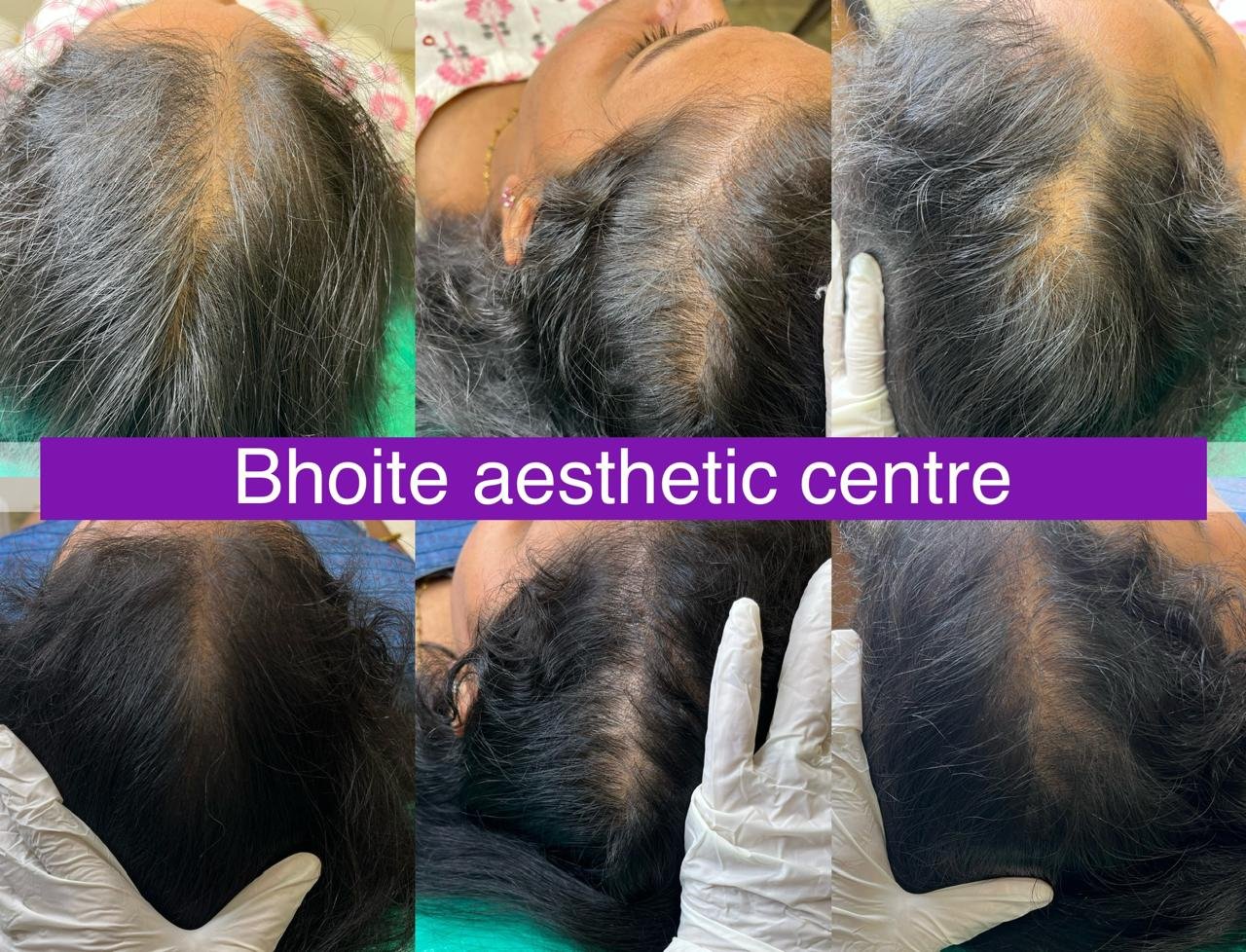 Hair restoration before and after