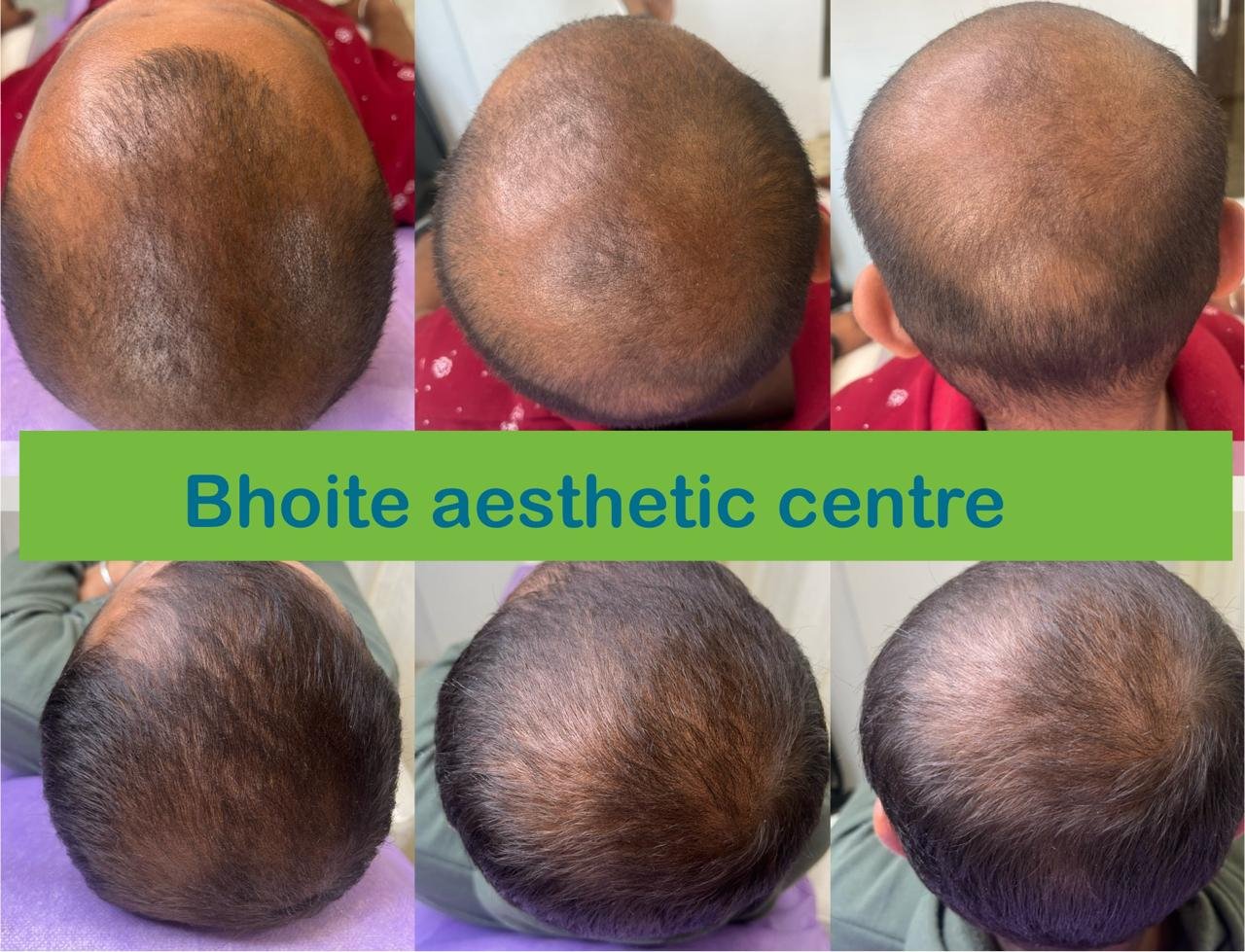 Eyebrow restoration results