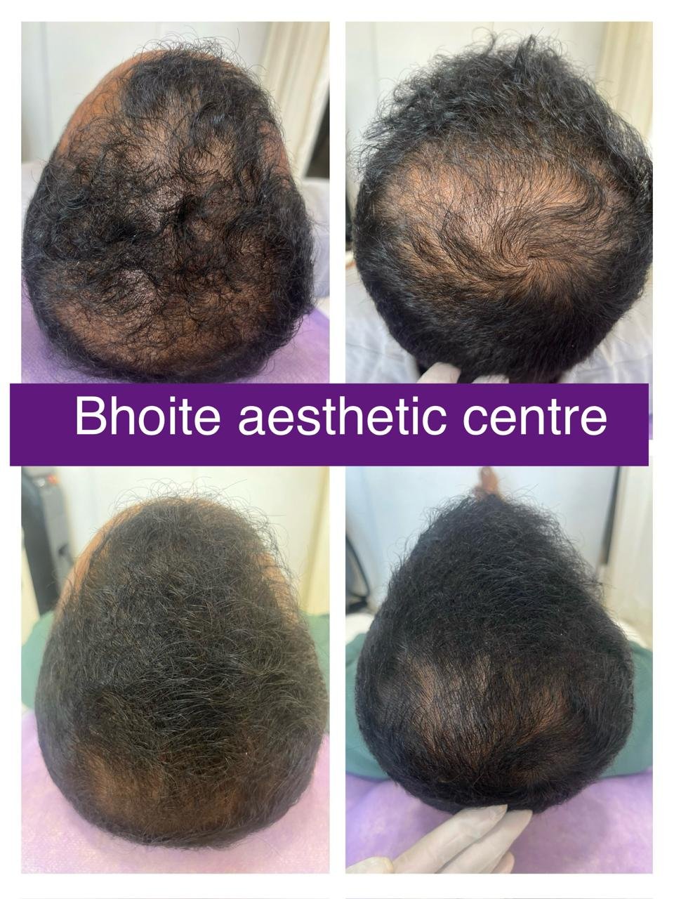 Eyebrow restoration results