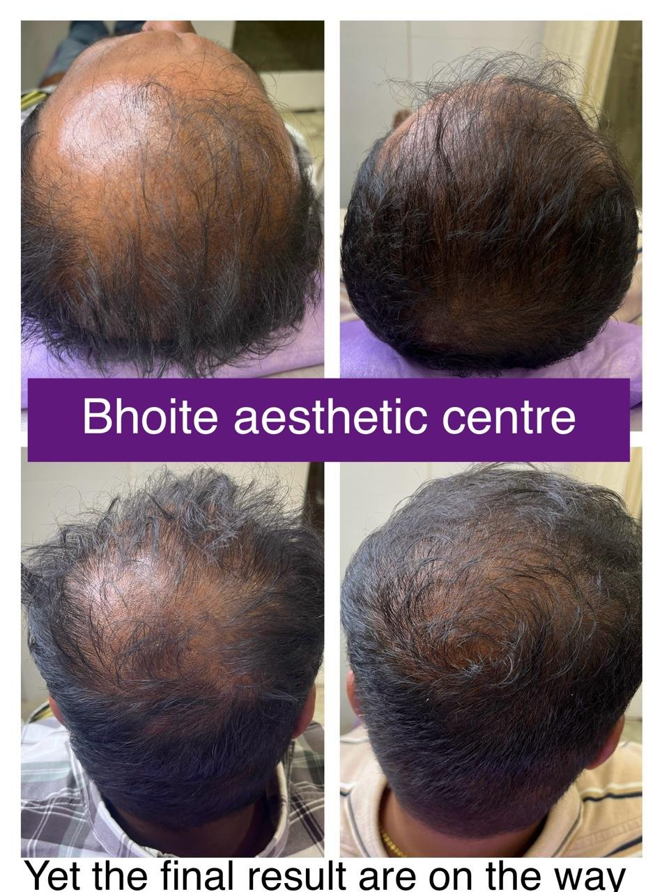 Eyebrow restoration results